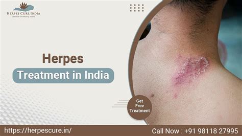 Herpes Cure Treatment in India: Exploring Options and Advances | by Herpes cure india | Jun ...