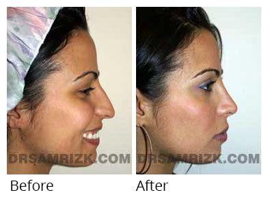 Female Rhinoplasty Gallery Before After Nose Job