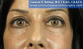 Under Eye Fraxel Laser Before And After Photos Dr Cameron Rokhsar