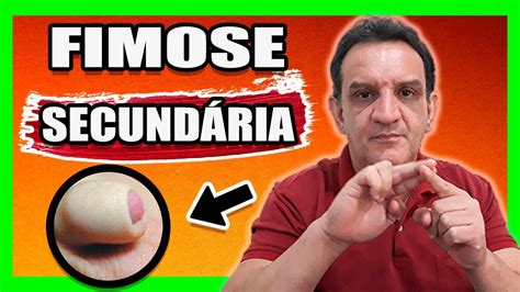 Fimose Secundária Veja O Que Esse Tipo De Fimose Pode Causar Youtube