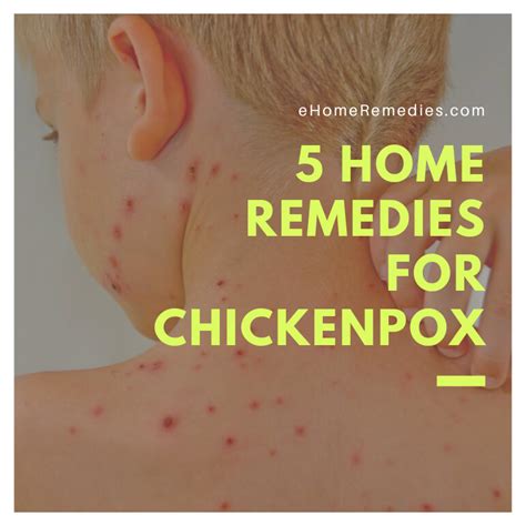 5 Home Remedies For Chickenpox