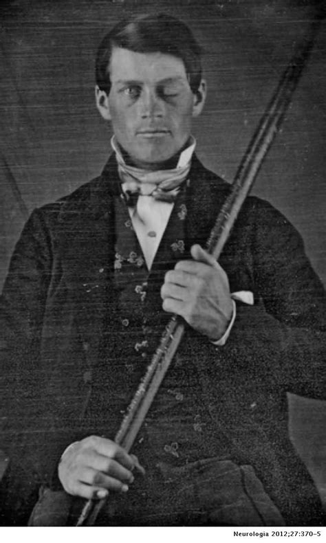 Phineas Gage And The Enigma Of The Prefrontal Cortex Neurología