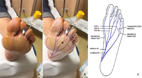 Figure From Ultrasound Guided Radiofrequency Ablation Of Mortons