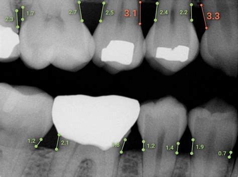 Ai Bone Level Measuring System Gets Fda Clearance Dentistry Today