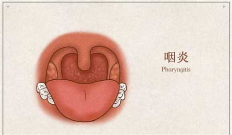 咽炎、咽喉腫痛？分享一個方，清熱滋陰，祛痰利咽，咽炎腫痛緩解