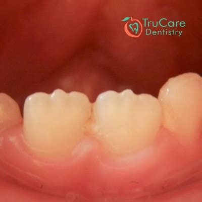 Mamelons on Teeth: What are they? How to remove them? – TruCare Dentistry