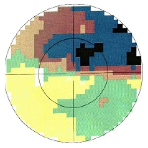 One example of visual field changes with NAION. (a) Before treatment ...