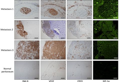 Immunohistochemical Ihc Staining Of Pax8 Vegf Cd31 And Hif 1α Was