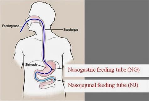 Nasojejunal Tube Placement Best Gastroenterologist In Ahmedabad