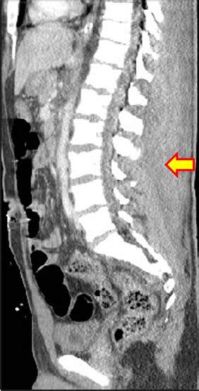 Sagittal Reformatted Ct Scan Of The Abdomen Shows Extensive Hematoma Download Scientific