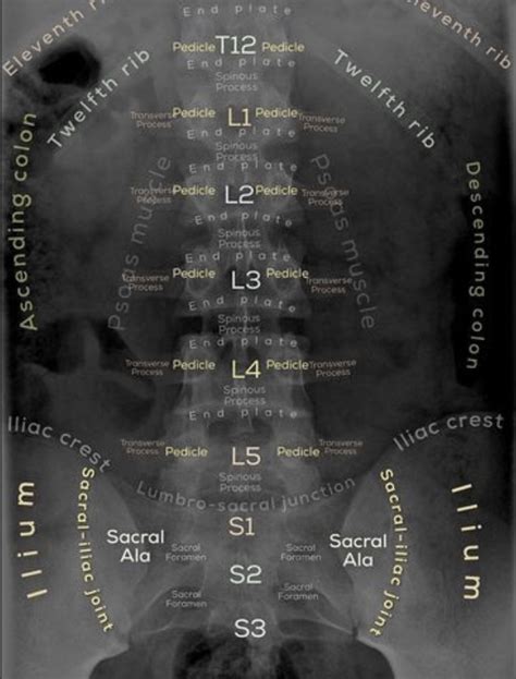 A Review On Reading Lumbar X Rays Sports Medicine Review