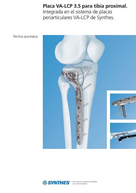 Placa Va Lcp Para Tibia Proximal T Cnica Quir Rgica Synthes