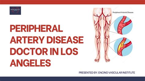 Ppt Peripheral Artery Disease Doctor In Los Angeles Powerpoint