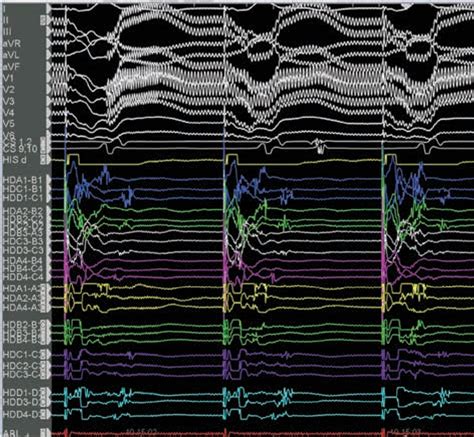 Figure 1 From Multipolar Mapping For Ventricular Tachycardia Ablation