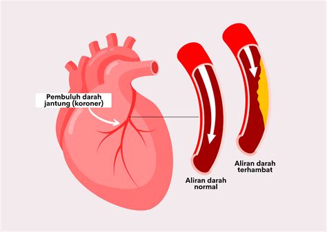Kenali Cegah Dan Tangani Penyakit Jantung Koroner Rumah Sakit Permata