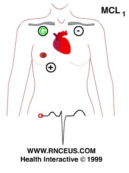 Ecg Electrode Placement Diagram