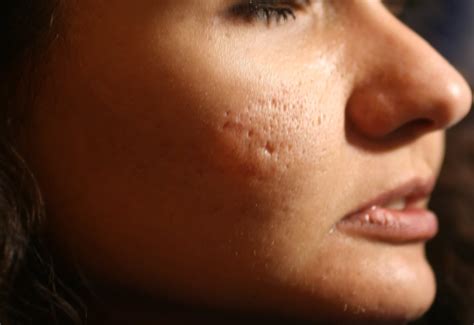 Acne Scar Laser Treatment and Types | Adorable Clinic