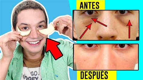 Como Quitar Las Ojeras Oscuras Y Bolsas De Ojos RÁpido Con Remedios Caseros Andyzaturno Youtube