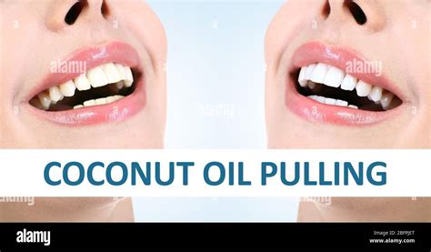 Coconut Oil Pulling For Teeth Whitening Demonstration Of Result Before