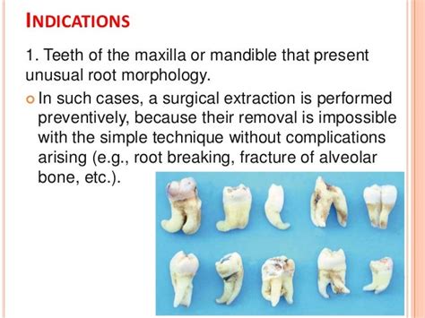 Principles and steps of surgical tooth extraction