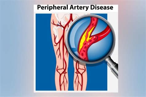 Peripheral Artery Disease Pad Research Nhlbi Nih