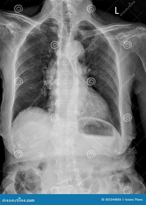 Chest Imaging In Cancer Or Tuberculosis Patient TB Snd Ca Lung Aortic