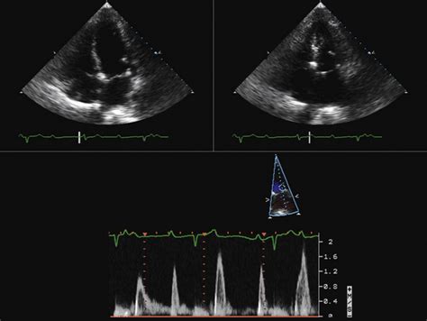 Echocardiographic Assessment Of The Left Ventricle Thoracic Key