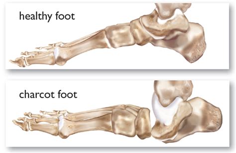 Complications With Charcot Foot International Orthotic Labs Inc