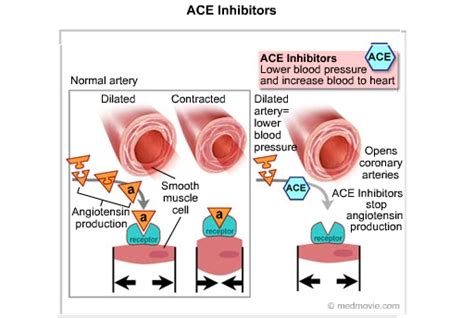 ACE Inhibitors | Cardiac Health