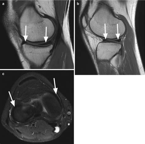 Meniscus Anatomy Mri