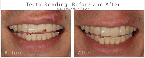 Teeth Bonding Before And After Seattle Shor Dental