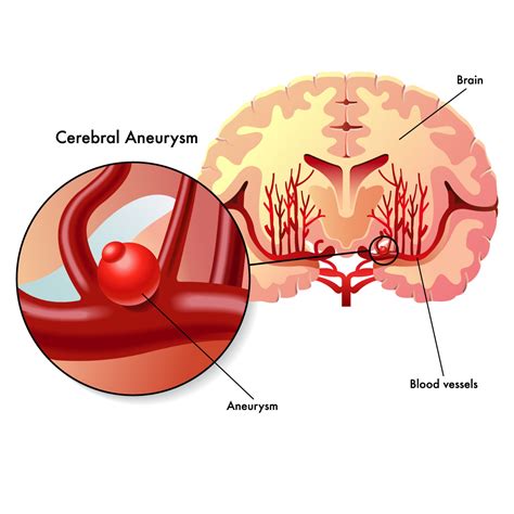 Aneurysm - Vejthani Hospital | JCI Accredited International Hospital in ...