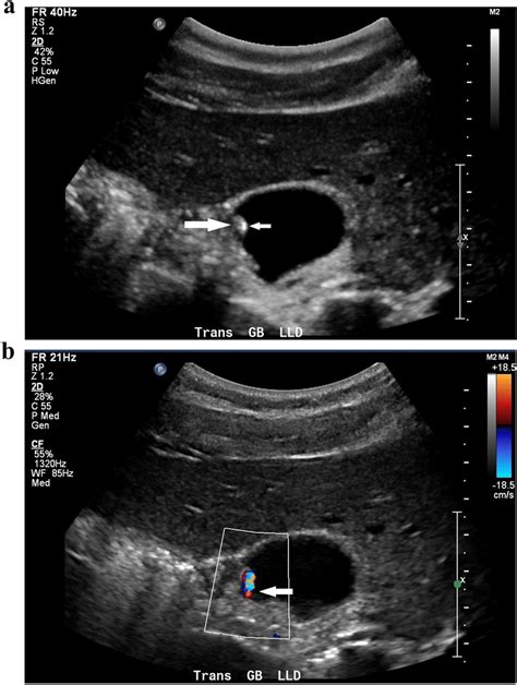 Pseudopolyp Exhibiting Color Comet Tail Artifact A Ultrasound Of The