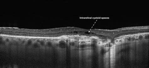 Macular Optical Coherence Tomography Oct Scan Of A Patient With