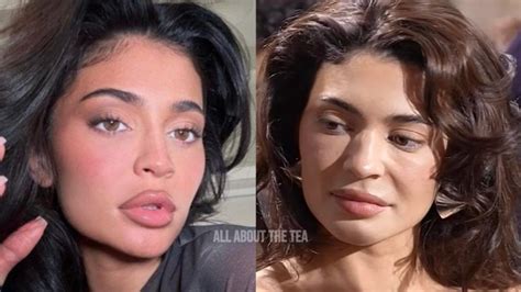 Shocking Kylie Jenners Face Collapses After Removing Fillers… She