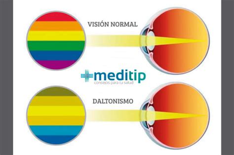 Daltonismo definición tipos y diagnóstico Meditip