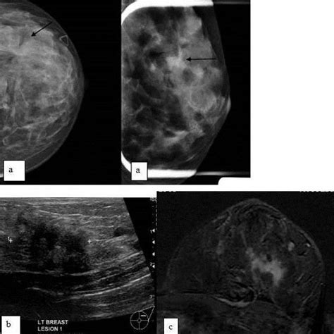 44 Year Old Lady Presented With A Palpable Lump In Upper Outer Quadrant