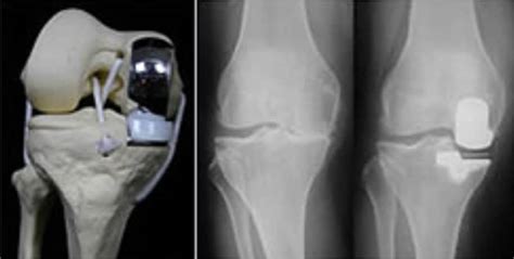 Mobile Bearing Unicompartmental Knee Replacement Dr Edward Shin Md