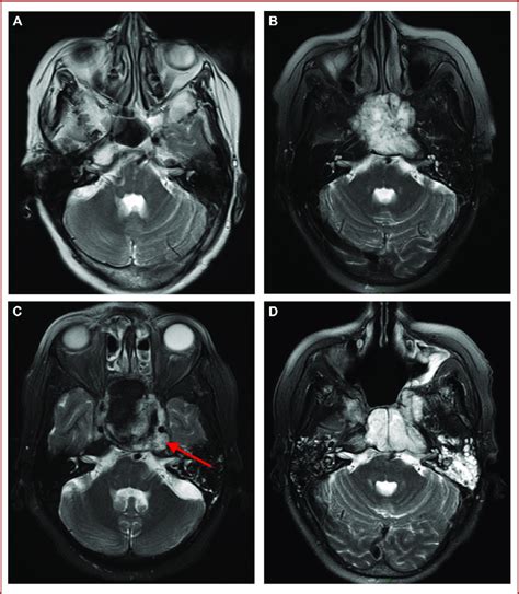 Axial T2 Weighted MRI Showing A Clival Chordoma Characterized By A High