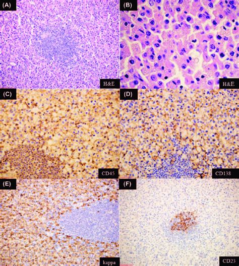 Plasma Cell Lymphoma Lymph Node A B Monotonous Infi Ltrates Of