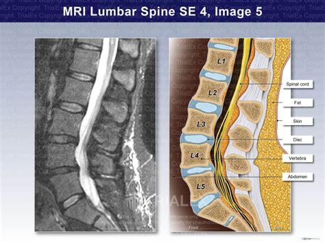 MRI Lumbar Spine - Trial Exhibits Inc.