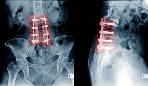 Posterior Lumbar Decompression And Fusion Surgery Pldf Surgery