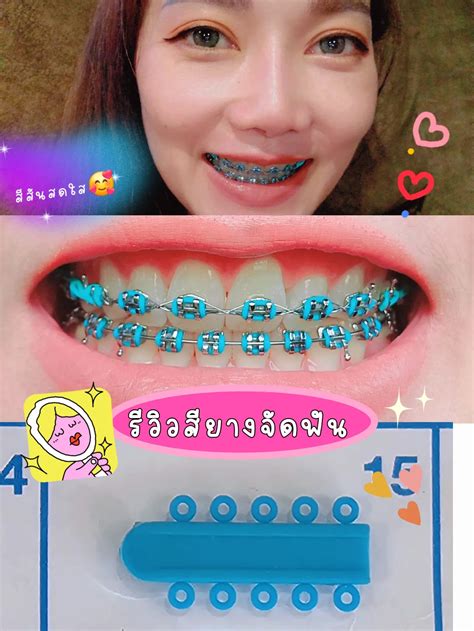 รีวิวสียางจัดฟันใช้สีนี้ขาวสีสันสะดุดตา🤗 แกลเลอรีที่โพสต์โดย ตามใจรีวิว💋 Lemon8