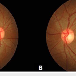 Both eye fundus photo showed bilateral macula edema (white arrow) with ...