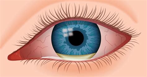 Eye Infections: Symptoms, Causes and Types - Scope Heal