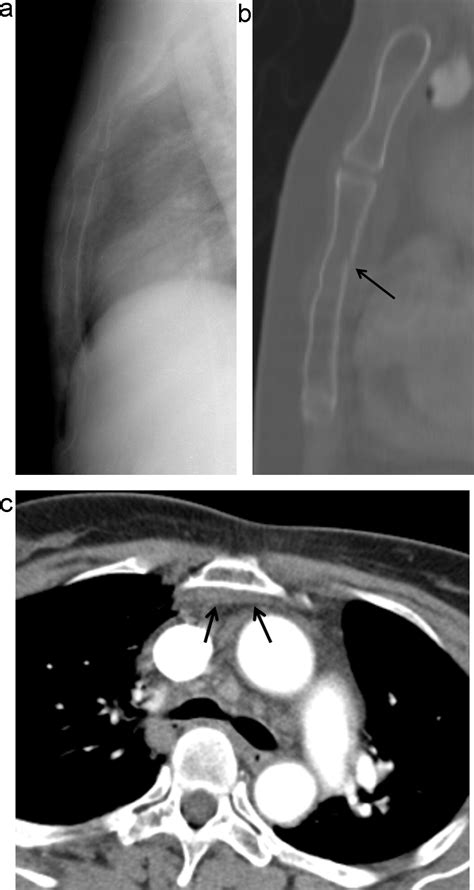 Sternal Fracture In The Emergency Department Diagnostic Value Of