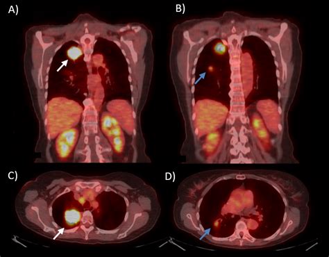 Two Distinct Primary EGFR Mutated Lung Adenocarcinoma Within The Same