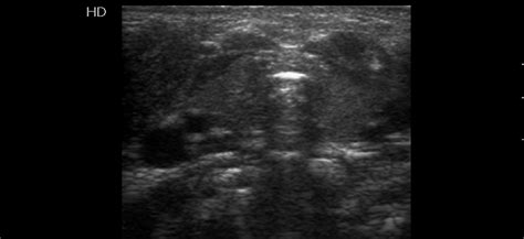 Fibromatosis Colli Image