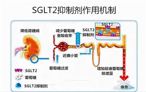 “尿中排糖，心肾双重获益”——sglt2抑制剂知多少