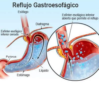 Reflujo Gastroesof Gico